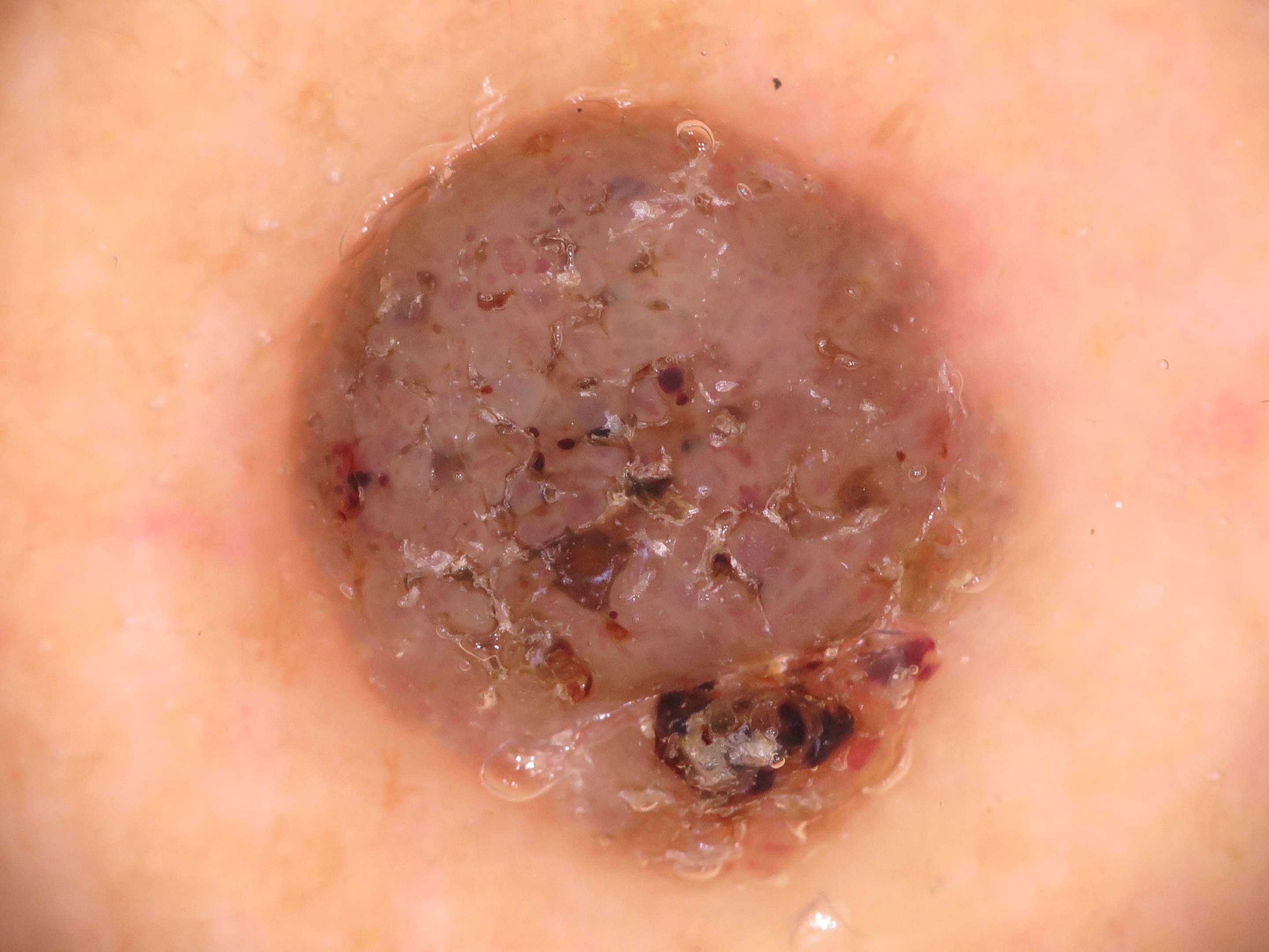 皮膚の良性腫瘍