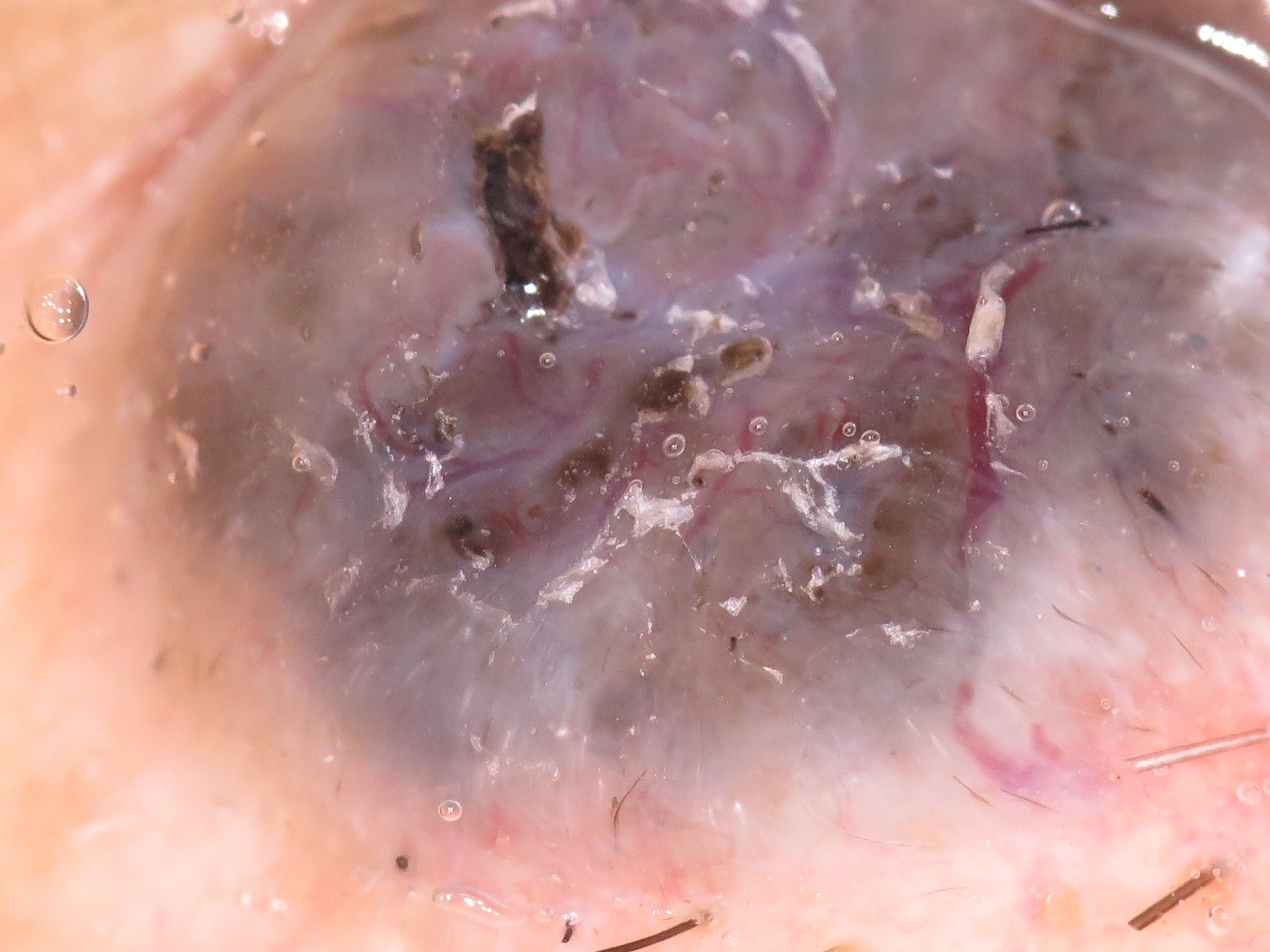 悪性腫瘍